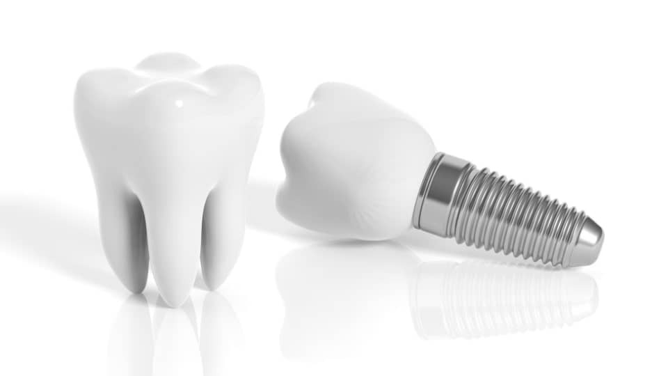 3d Model Dental Implants Compared To A Normal Tooth