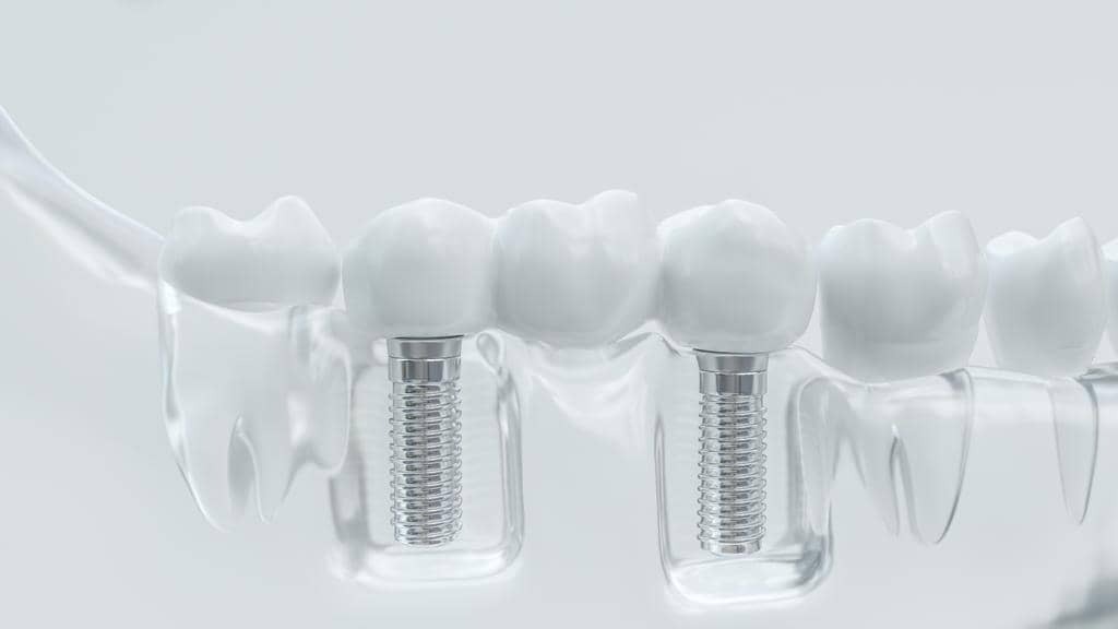 3d Model Of Dental Implants In Transparent Jaw