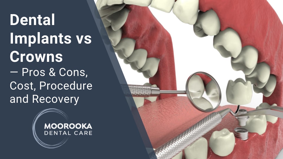 Dental Implants vs Crowns