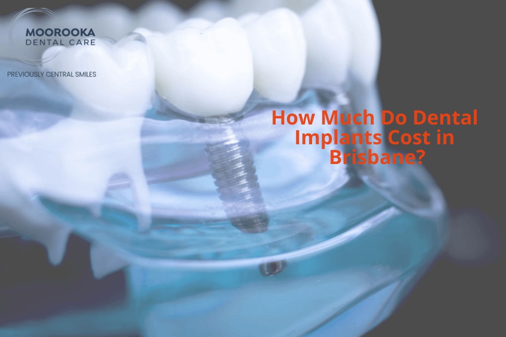 How Much Do Dental Implants Cost In Brisbane