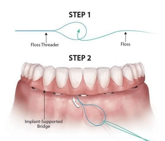 Steps To Cleaning All On 4 Dental Implants