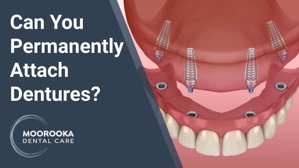 Can You Permanently Attach Dentures?