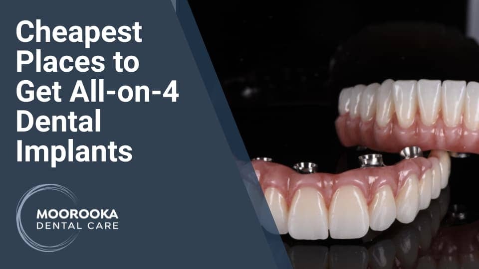 Most Affordable Places to Get AllOn4 Dental Implants