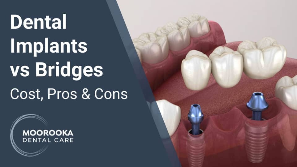 Dental Implants Vs Bridges - Costs, Pros & Cons