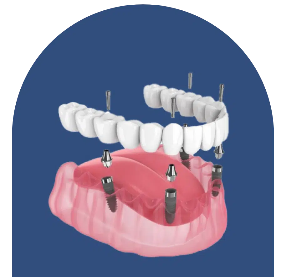 Dentures Brisbane