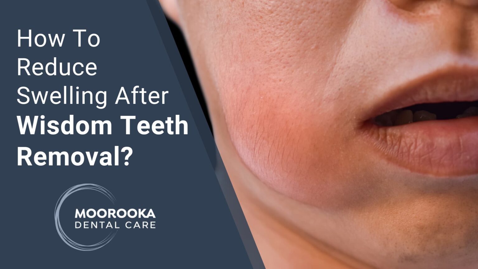 How To Reduce Swelling After Wisdom Tooth Extraction? Tips For Wisdom Tooth Removal Relief